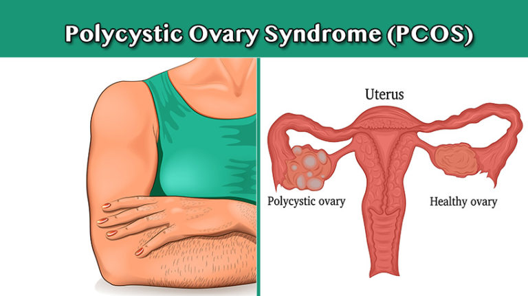 Warning Signs Of Polycystic Ovary Syndrome PCOS That Every Woman
