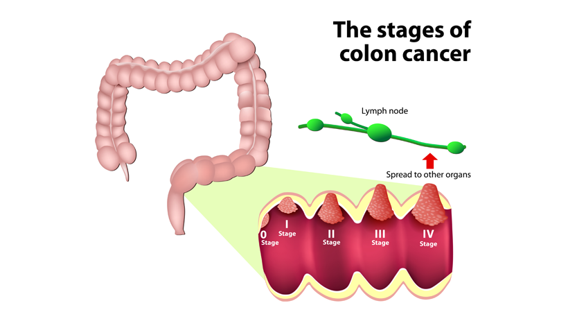 5 Hidden Dangers of Colon Cancer - WomenWorking