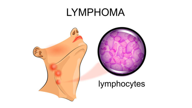 8 Signs Of Lymphoma To Know About Womenworking