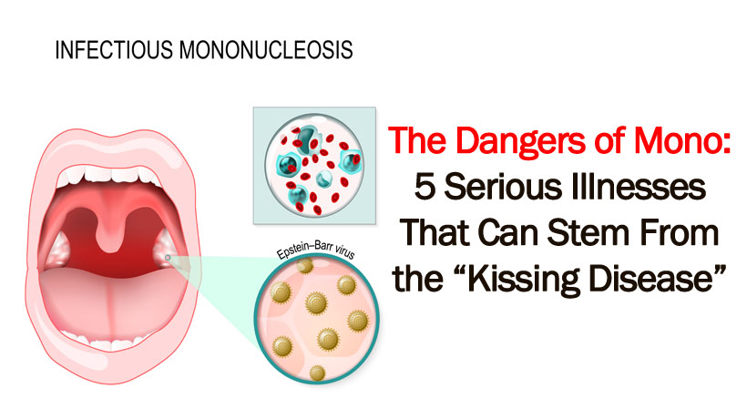 Korrektur Verwirrt Linderung The Kissing Disease Auslassen Sanft Kaskade