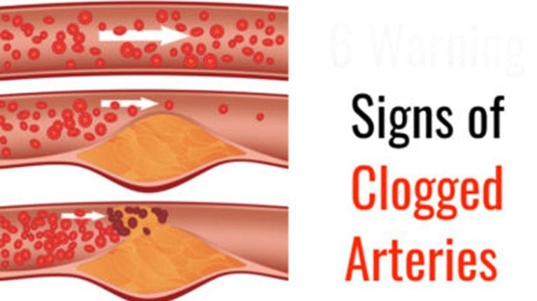 6 Signs of Clogged Arteries - WomenWorking