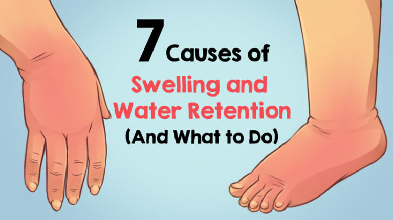 7-causes-of-swelling-and-water-retention-and-what-to-do-womenworking