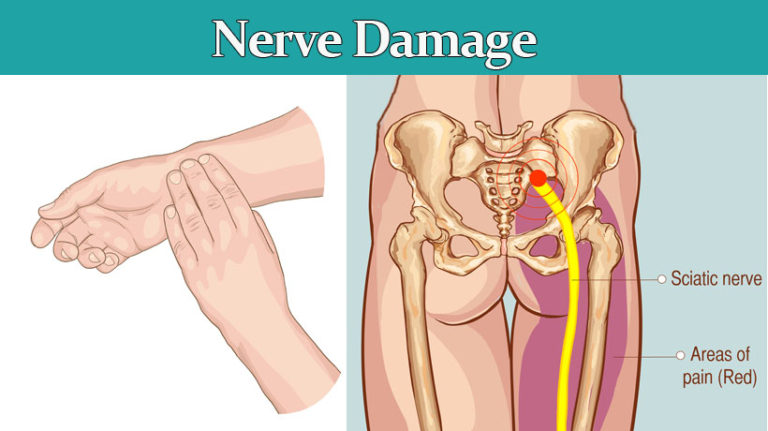 8-symptoms-of-nerve-damage-that-may-be-serious-womenworking