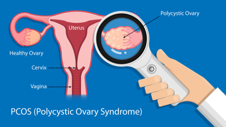 4 Dangerous Conditions That Affect Your Ovaries That Every Woman Should ...