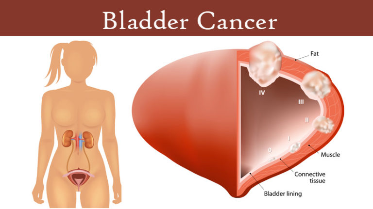 Signs Of Bladder Cancer To Know About Womenworking