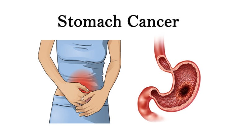 5 Warning Signs It Could Be Stomach Cancer Womenworking