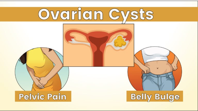 5 Warning Signs Of An Ovarian Cyst That Could Become Dangerous Womenworking