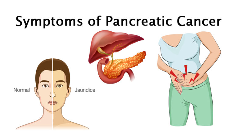 Pancreatic Cancer Wp Womenworking 6825