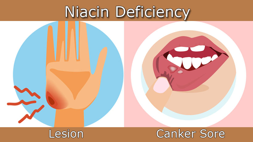 niacin deficiency
