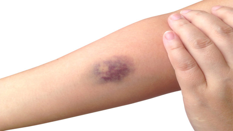 7-not-so-obvious-reasons-for-bruising-easily-womenworking