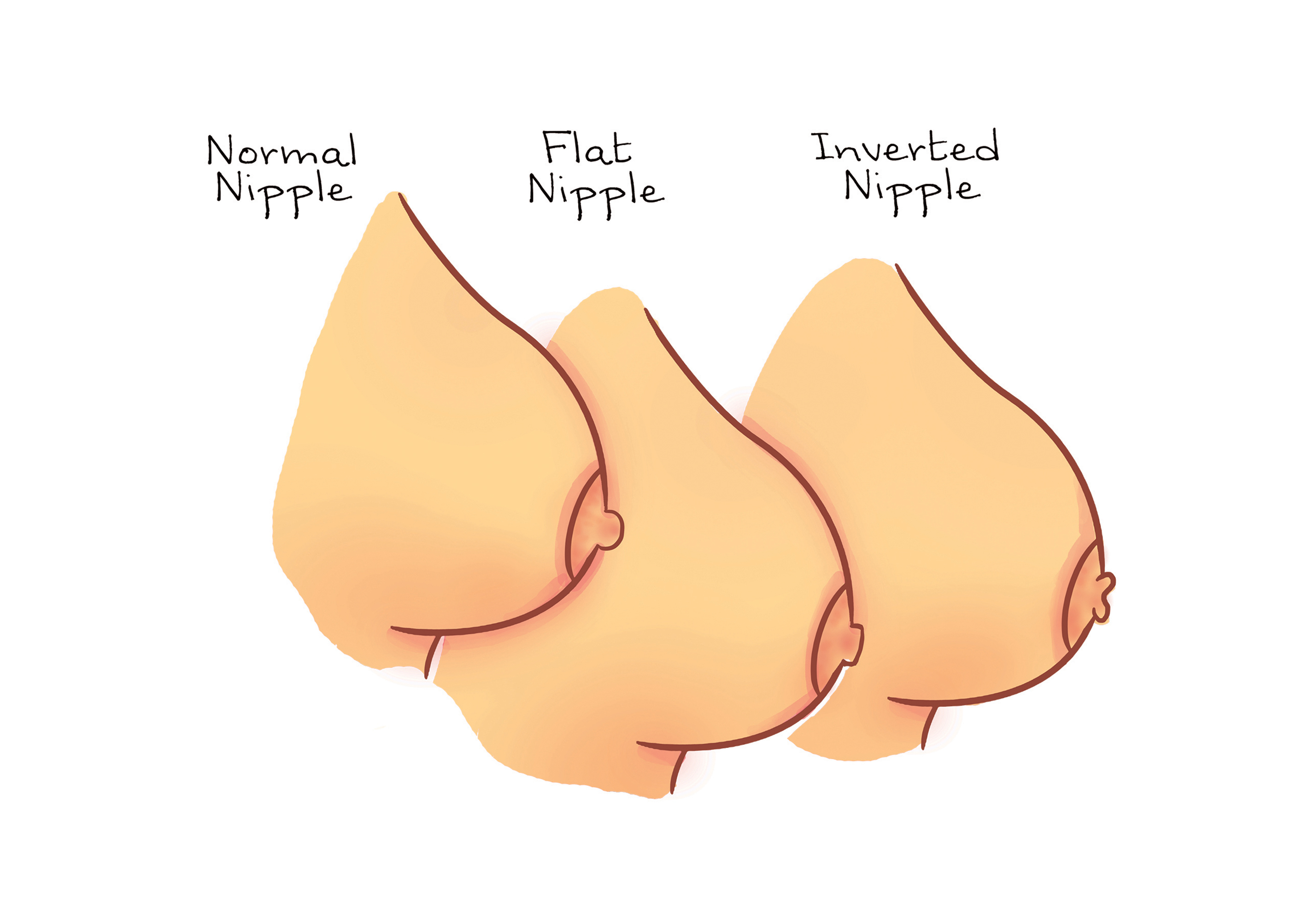 Healthy breast and changes in nipple shape, illustration - Stock