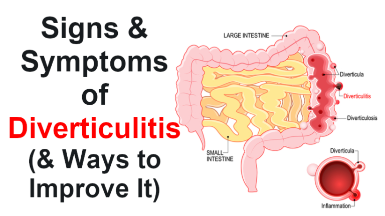 Signs And Symptoms Of Diverticulitis And Ways To Improve It Womenworking 6232